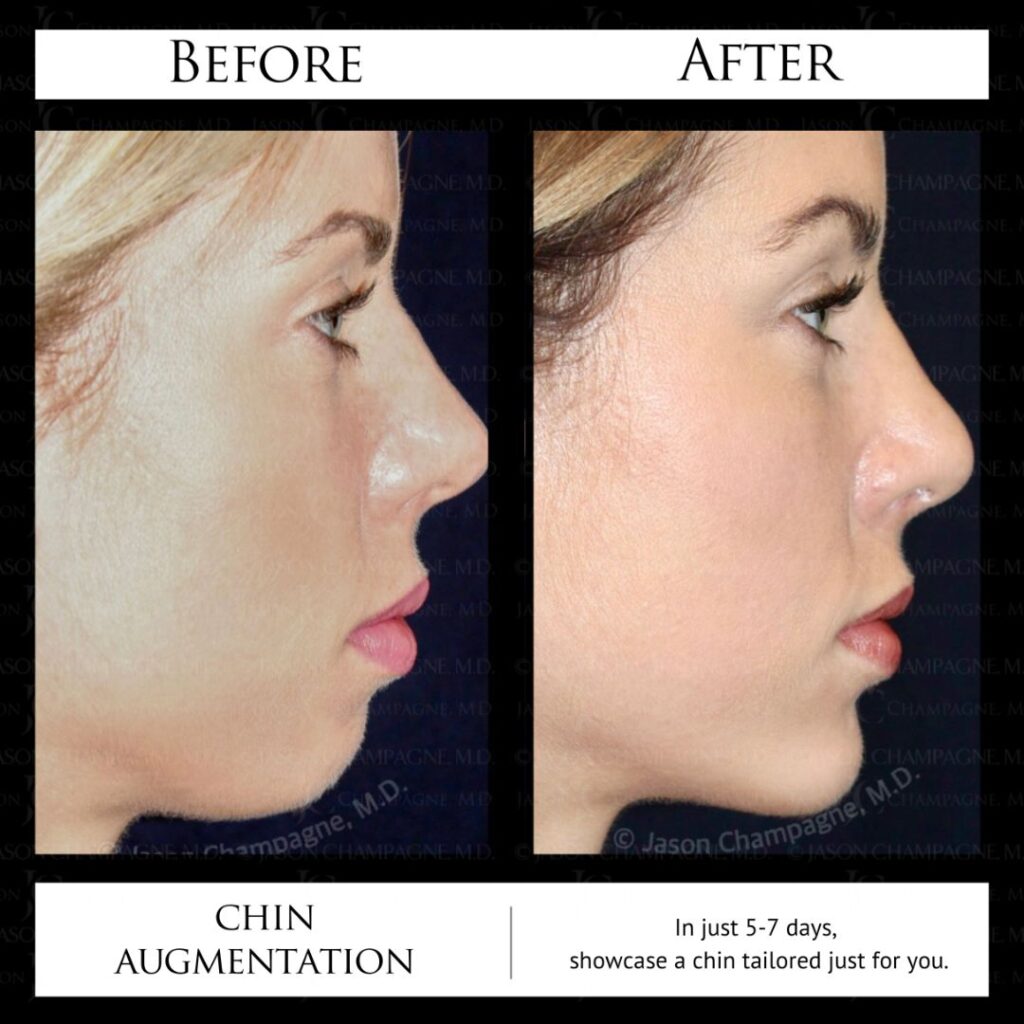 Get That Perfect Celebrity Jawline — Plastic Surgeon Beverly Hills, CA